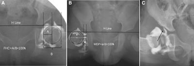 Hip arthrogram parameters predict radiographic outcomes of patients with developmental dysplasia of the hip treated by closed reduction